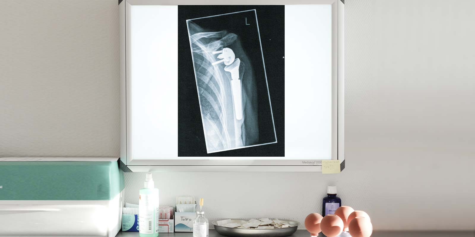 Roentgenbild der Schulter